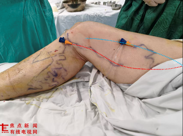 图2 双大隐静脉曲张腔内射频闭合.png 图2 双大隐静脉曲张腔内射频闭合.png